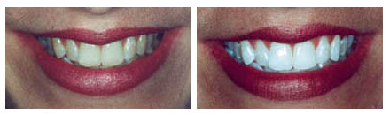 Whitening